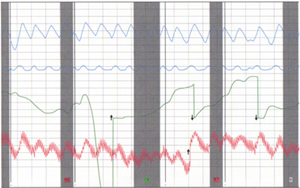 Polygraph Chart produced by our polygraph analysis examiners.